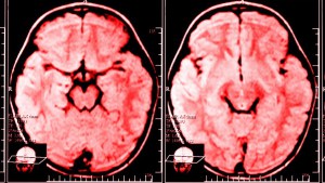 brain 1